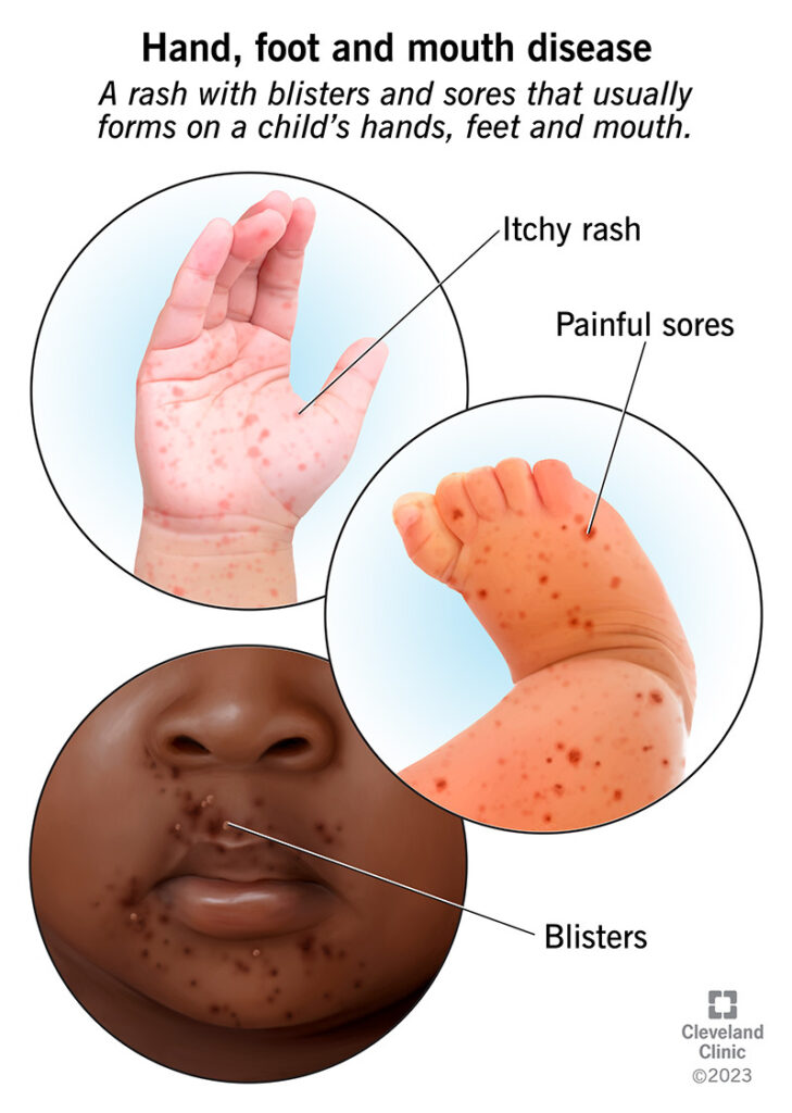 Foot Hand And Mouth Disease Symptoms