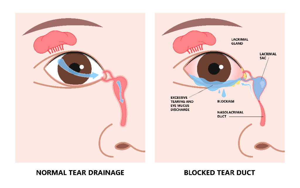Tear Duct Blockage Surgery